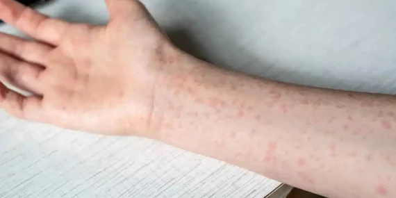 Endonezya’da kızamık salgını: 17 kişi hayatını kaybetti